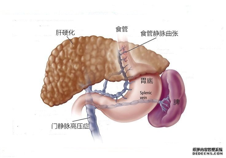 liver_varices_.jpg